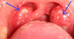 signs-throat-infection-need-best-ent-doctor-nyc-02