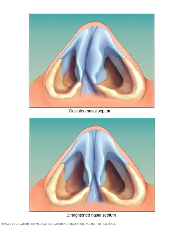 Deviated septum ENT specialist NYC