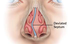 Deviated Septum | Septoplasty Surgeon NYC