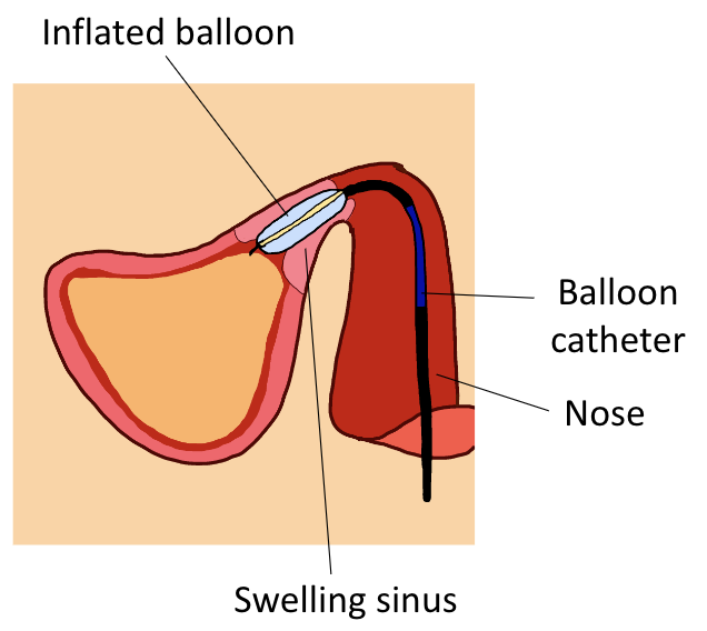 Best_Balloon_sinuplasty_NYC